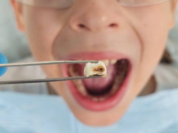 Best Emergency Tooth Extraction in Hampstead, MD